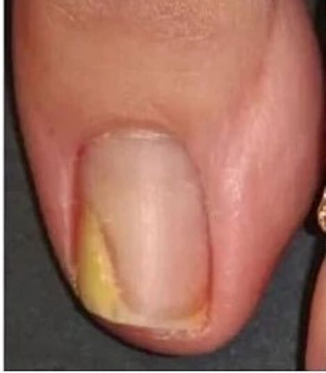 uña do pé con fungo antes do tratamento