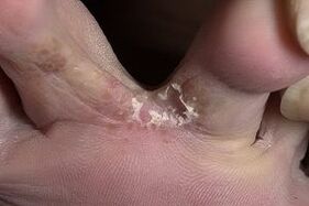 síntomas de fungo nos pés