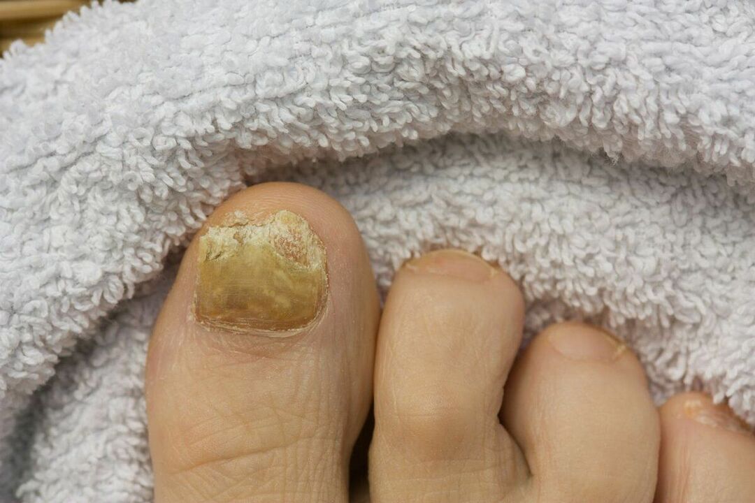 causas dos fungos nas unhas dos pés