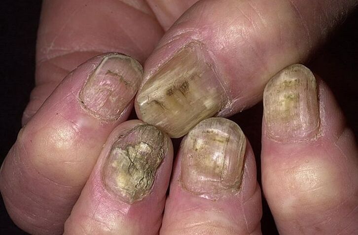 Deformación, separación e desmoronamento das uñas por fungo