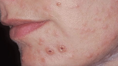 Infección fúngica da pel da cara