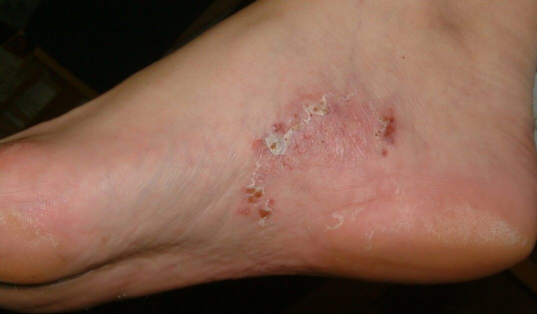 Manifestacións dunha infección fúngica no pé