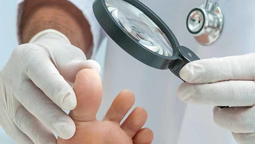 O diagnóstico da fungo das unhas dos pés é realizado por un dermatólogo